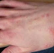 Výskyt svrabu v ČR narůstá, není ale důvod k panice. Onemocnění lze efektivně zvládnout díky informacím a prevenci